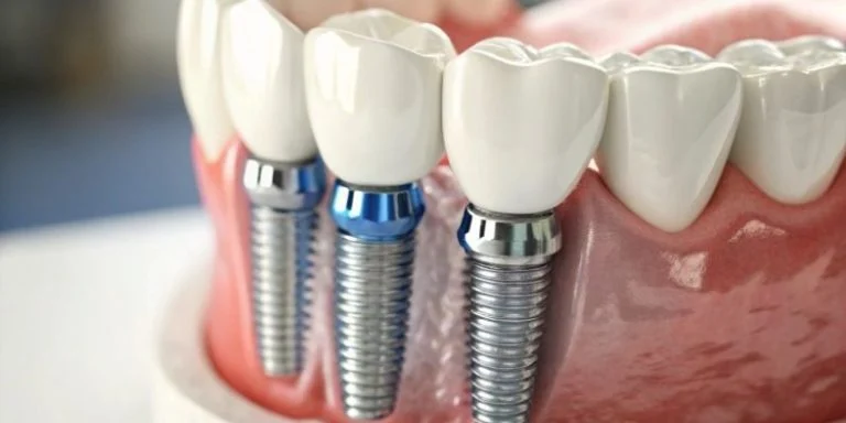 how-to-know-if-youre-a-candidate-for-dental-implants-after-tooth-loss