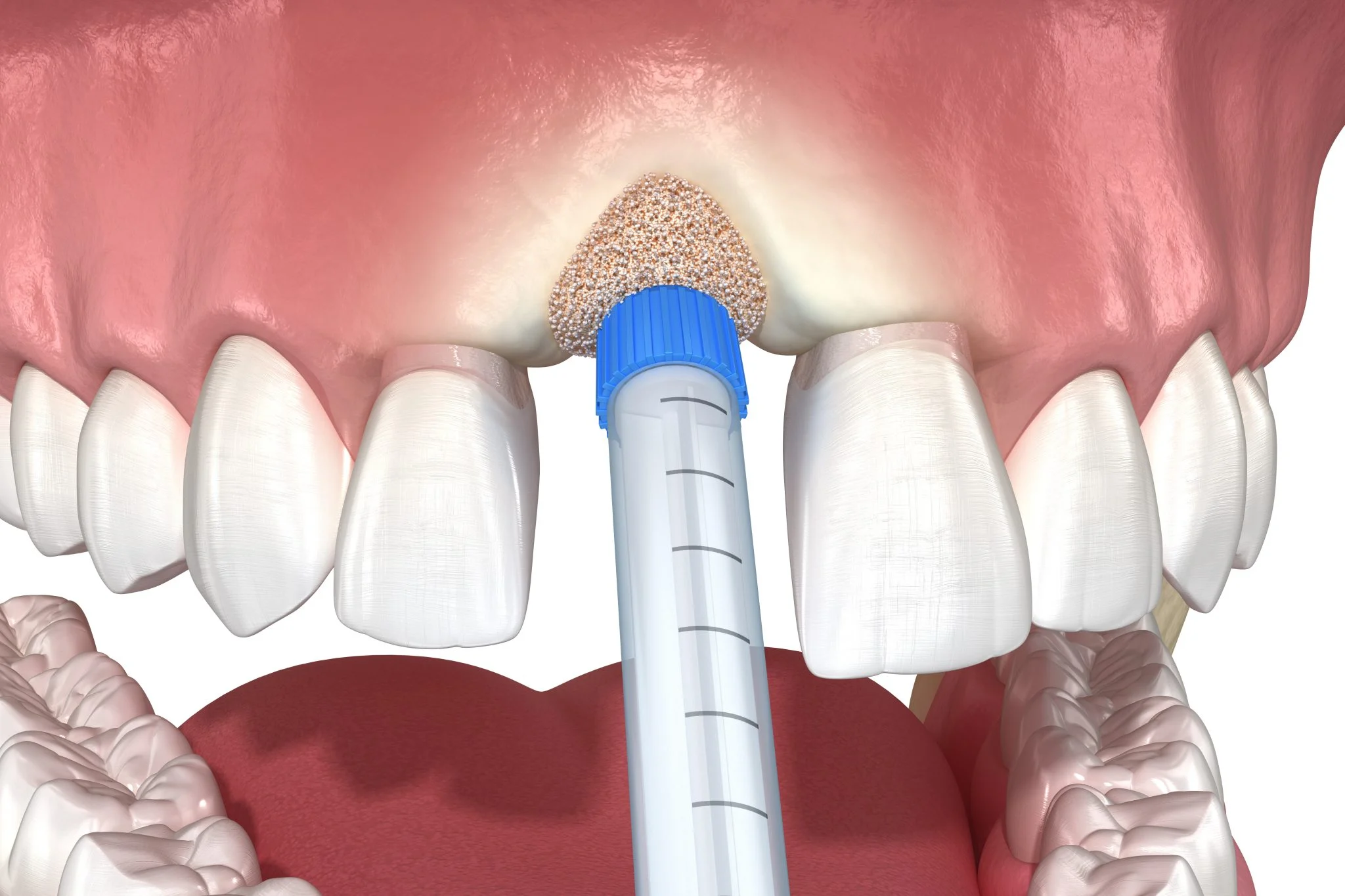 Restoring Your Jaw Bone for Successful Dental Implants