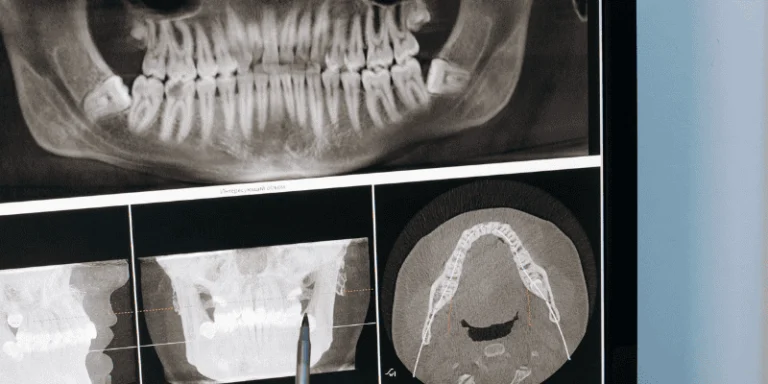 Jawbone loss after tooth extraction begins