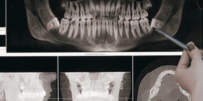 Strategies to Optimize Bone Health and Implant Stability