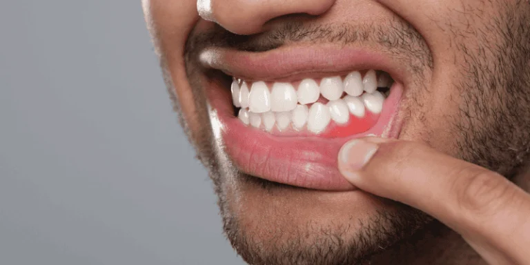 gum disease and implant eligibility