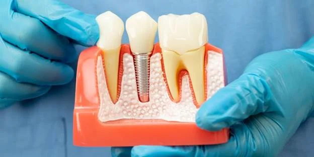 the-rise-of-dental-implants