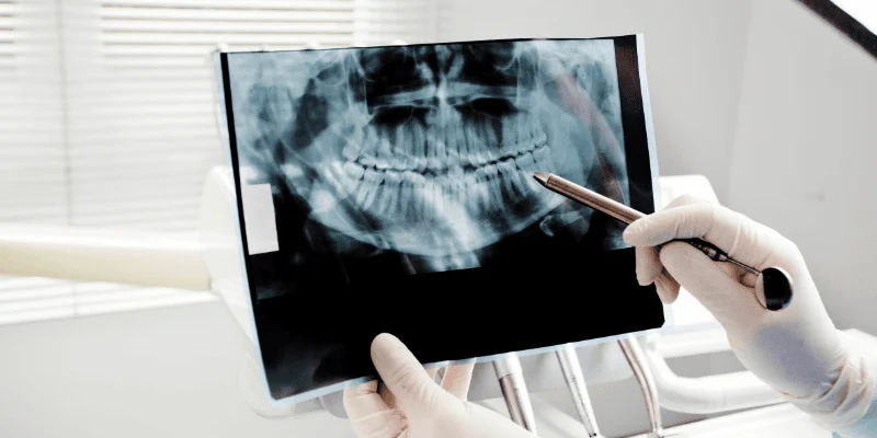 implant stability factors