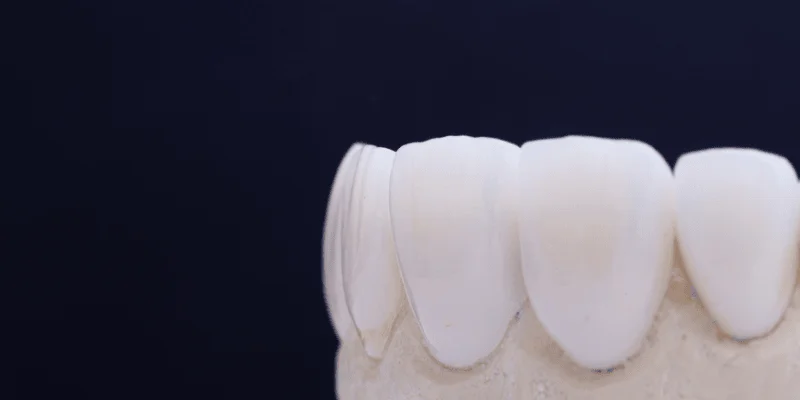 implants vs future dental costs