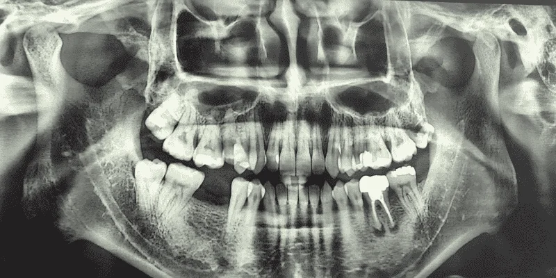 X-ray showing risks of delaying tooth replacement