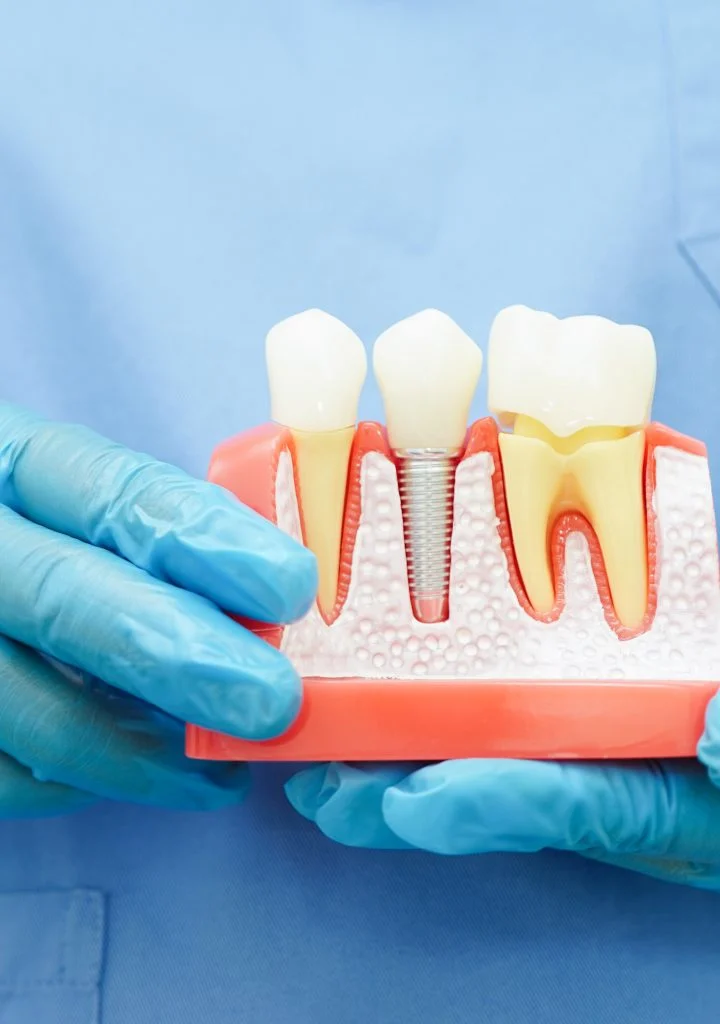 who-are-same-day-dental-implants-for